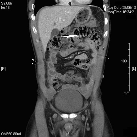 Slice from the CT abdomen showing the position of the nail in the abdomen.