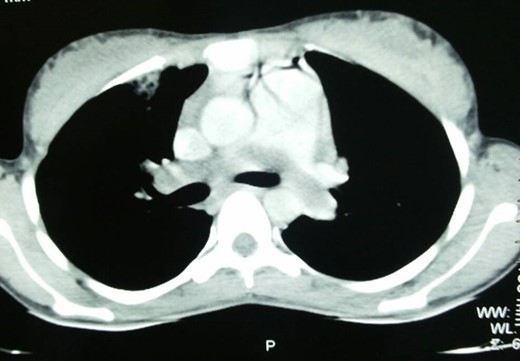 A CT scan image showing thrombus in the pulmonary artery.