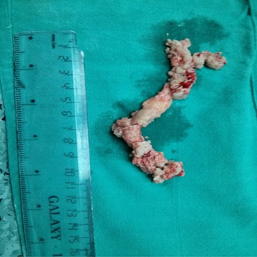 Thrombus.
