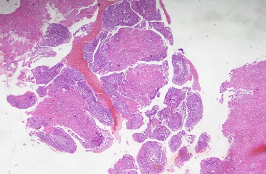 Histopathological image showing the trophoblastic elements.