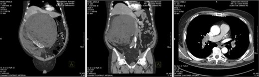 Thoracic and abdominal CT—right perirenal retroperitoneal liposarcoma with massive secondary thromboembolism.