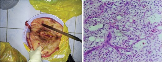 Perirenal myxoid liposarcoma—macroscopic appearance (left) and microscopic appearance (right).