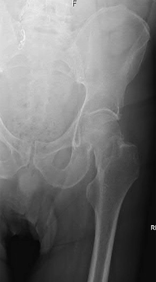 Anteroposterior (AP) radiograph of the left hip demonstrating a complete and partially displaced, intracapsular fractured neck of femur.