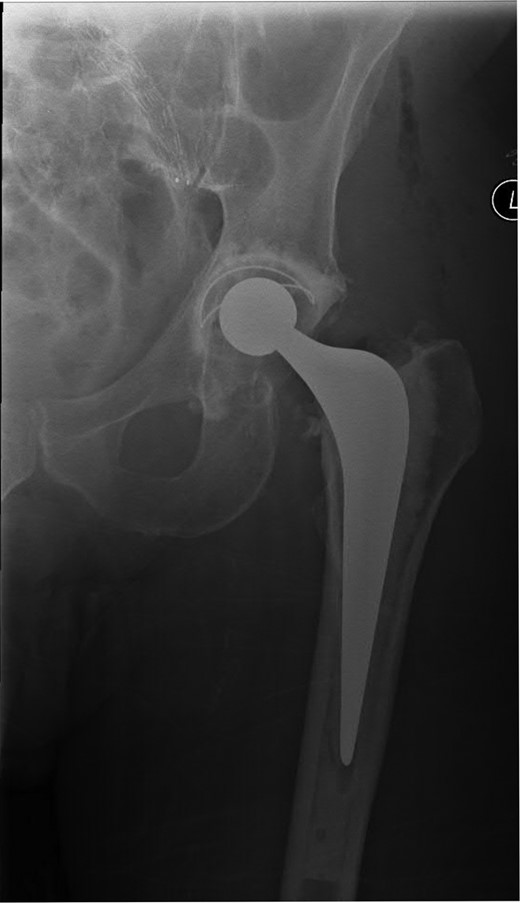 Postoperative AP radiograph with a cemented left THR in situ.
