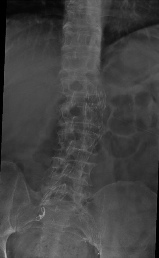 AP radiograph of the lumbar spine demonstrating the aortouniiliac EVAR with coil embolization of the right CIA.