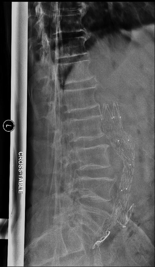 Lateral radiograph of the lumbar spine demonstrating the aortouniiliac EVAR with coil embolization of the right CIA.