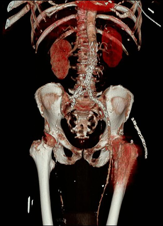 CT angiogram with three-dimensional reconstruction revealing a filling defect to the right lower limb with an absence of collateral circulation.