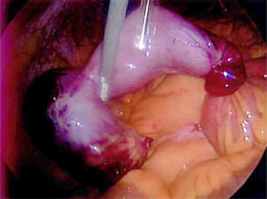Axial rotation and gangrene of the Meckel's diverticulum.
