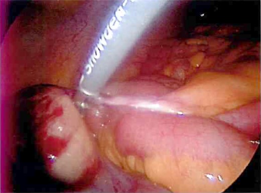 Mesodiverticular band connecting the tip of the Meckel's diverticulum to adjacent small bowel mesentery.