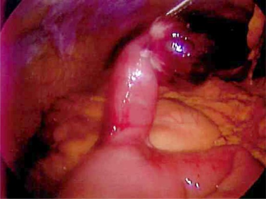 De-torsed diverticula revealing a normal appearing base.