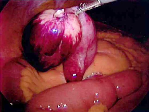 Excised Meckel's diverticulum before removal from the abdomen.