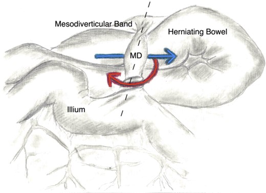 This illustration depicts the mechanism of torsion and small bowel herniation. The red line represents the rotation of the Meckel's diverticulum (MD) around axis created by the mesodiverticular bands attachment to adjacent mesentery and the ilium (the dotted line). The blue arrow shows the path in which the bowel herniates and thus propagating the rotation of the MD.