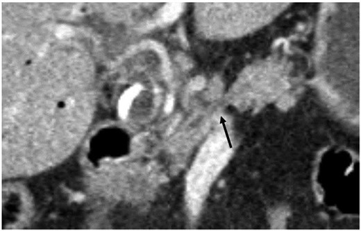 Coronary abdominal CT scan: missing pancreatic isthmus with isolated pancreatic duct (arrow).