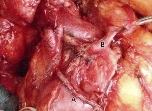 Situs after pylorus-preserving transsection of the duodenum with stapled duodenum (A) and pancreatic duct (B) crossing the portal vein.