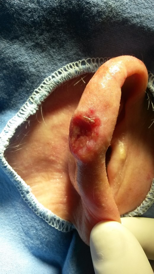 Aspect of the cutaneous tumor on physical examination.