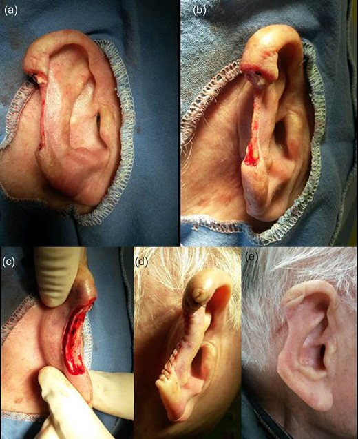 Tumor removal. (a) Anterior view, (b) lateral view, (c) posterior view, (d) immediately postoperative and (e) 60th postoperative day.