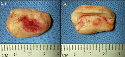 Surgical specimen. (a) Anterior view and (b) posterior view. Special detail of cartilage removed en bloc with free margins.