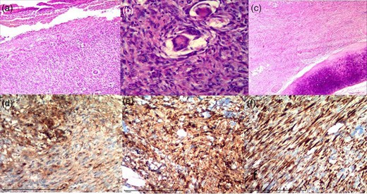 Above: photomicrographs of sections stained with hematoxylin–eosin: (a) presence of ulceration (×100), (b) presence of nuclear atypia, mitoses and giant cells (×400) and (c) presence of deep dermis and subcutis invasion; free cartilage (×100). Below: photomicrographs of IHC analysis with the following markers: (d) alpha-1-antitrypsin, (e) CD68 and (f) vimentin.