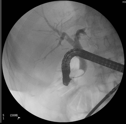 Intraoperative ERCP image.