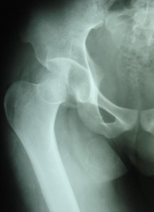 Initial X-ray: pelvis with both hips (anteroposterior view).