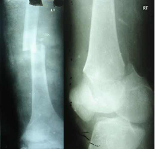 Initial X-ray: left thigh (anteroposterior view) and right knee (oblique view).