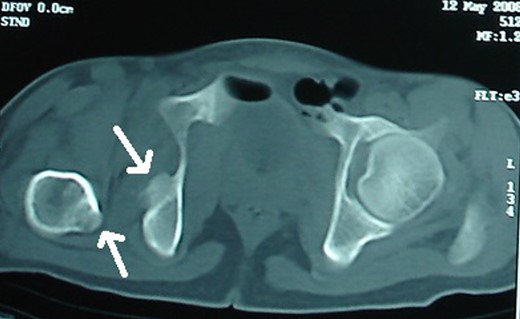 Initial CT scan: Pipkin's fracture (white arrow) with posterior dislocation right hip.