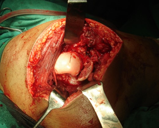 Intraoperative photograph: fracture fragments.