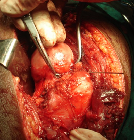 Intraoperative photograph: femoral head screw fixation.