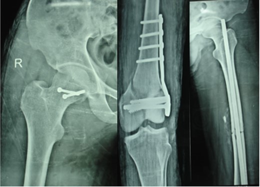 Immediate postoperative X-ray.