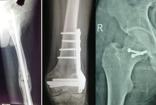 Postoperative X-ray at 1-year follow-up.