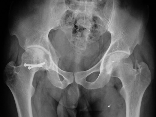 Postoperative X-ray at 7-year follow-up.