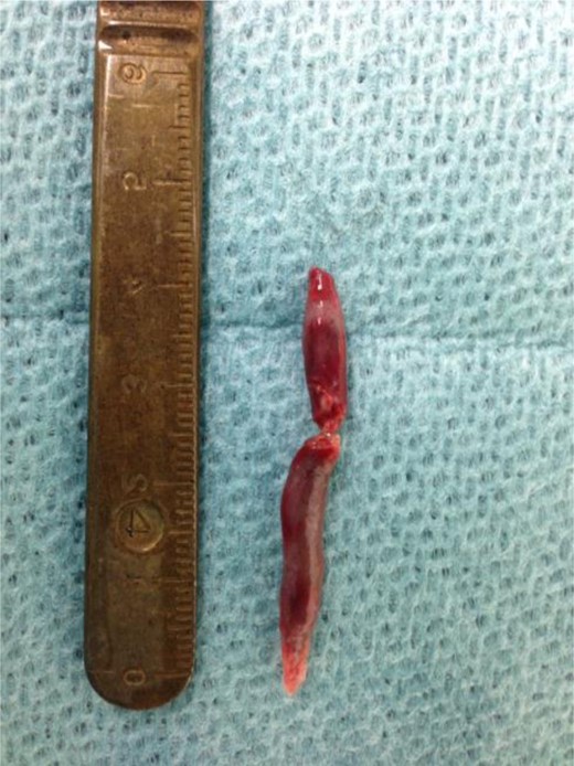 Thrombus (4 cm) removed from the right external iliac artery.