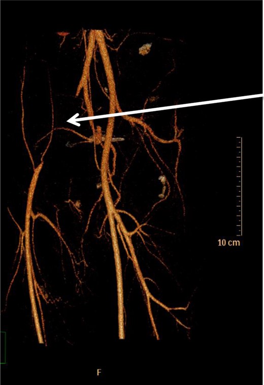 Occlusion of right external iliac artery 1 cm below its origin (white arrow). The right common femoral artery is supplied by inferior epigastric and lateral thigh collaterals. Left-sided vessels are normal.