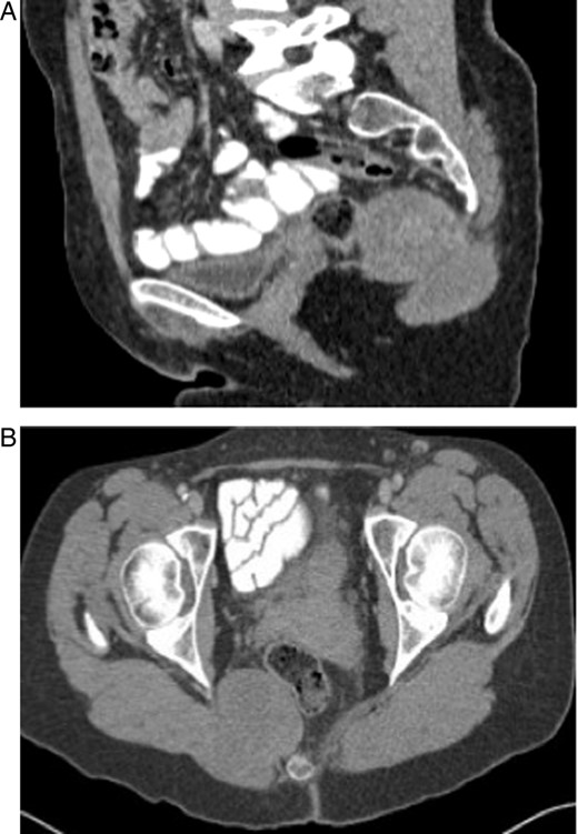 (A and B) CT scans of the tumour showing a bilobed mass within the ischiorectal fossa extending through the greater sciatic notch.