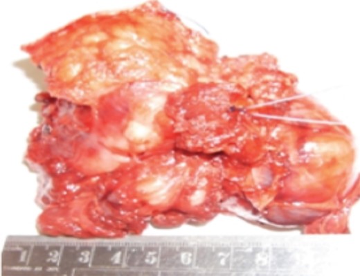 Pathological specimen.