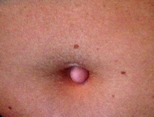 Preoperative appearance of the umbilical nodule. Note the previous piercing site at the 12 o'clock position.