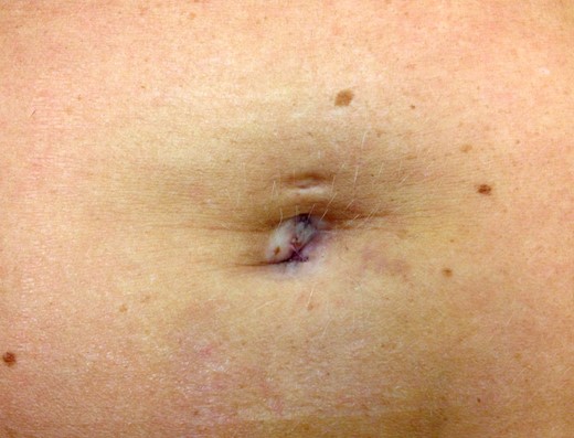 Postoperative result 2 months following intralesional excision.