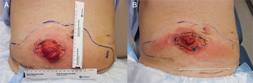 Original stoma site appearance on POD 14 (A) and POD 20 (B).