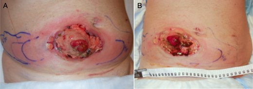 Improvement with multimodality treatment, from Day 23 (A) to Day 26 (B).