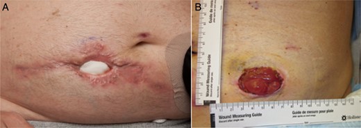 POD 70 (A) original stoma site and (B) new stoma site.