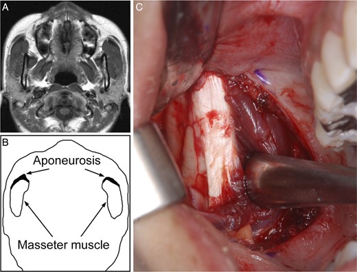 The characteristics of MMTAH. (A) MRI on horizontal section at the middle level of face. (B) Scheme illustrating bilateral ‘thick’ aponeurosis on the anterior of masseter muscle. (C) Right ‘thick’ aponeurosis before resection during surgery.