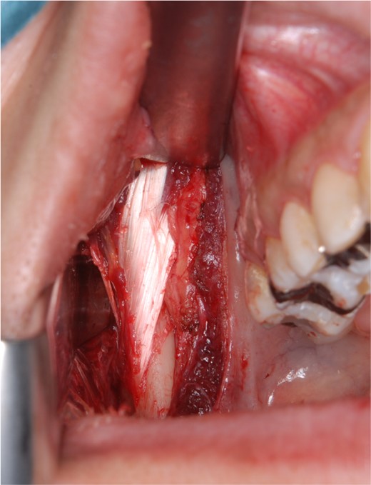 Right temporal muscle tendon before resection during surgery.