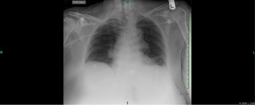 Upright portable chest X-ray without evidence of pneumoperitoneum, effusions or infiltrates.