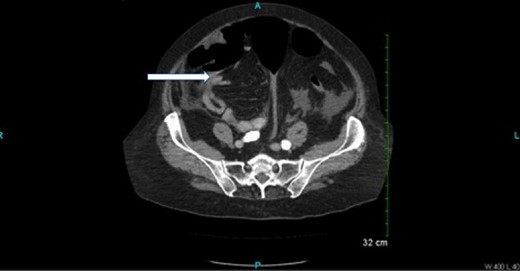 Oral and intravenous contrast enhanced CT of the abdomen demonstrating air within the colonic lumen and a 3.5 × 2.5 cm broad-based mass along the wall of the right colon (white arrow).