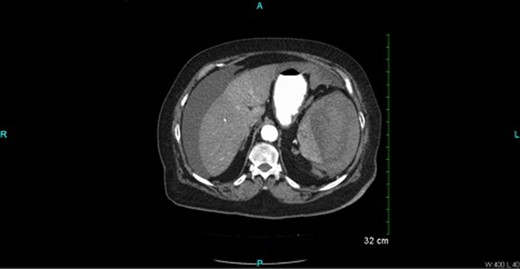Oral and intravenous contrast-enhanced CT of the abdomen demonstrating air within the colonic lumen and a large haematoma at the lateral margin of the spleen that displaced the spleen medially, compressing its lateral margin. A moderate amount of relatively low attenuation fluid is also seen tracking into the right paracolic gutter and perihepatic space.
