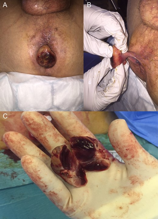 Photographs were taken by M.J.L. with permission. (A) Mass evident in lithotomy position. (B) Stalk at base of lesion. (C) Cut surface revealing renal-type tissue.