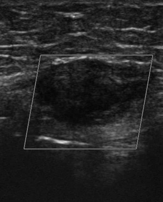 Ultrasound scan showing a hard 2 x 3cm lesion in her left rectus.