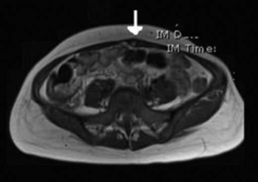MRI showing a benign lesion consistent with an intramuscular lipoma.