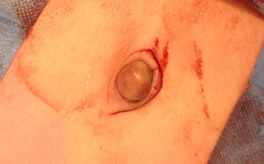 Clinical presentation of a livid, soft, painful swelling in the umbilicus, which could not be reduced by gentle digital pressure.