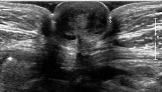 Ultrasonography of the umbilicus demonstrated a hypodense nodule of 1.8 cm in the umbilicus.